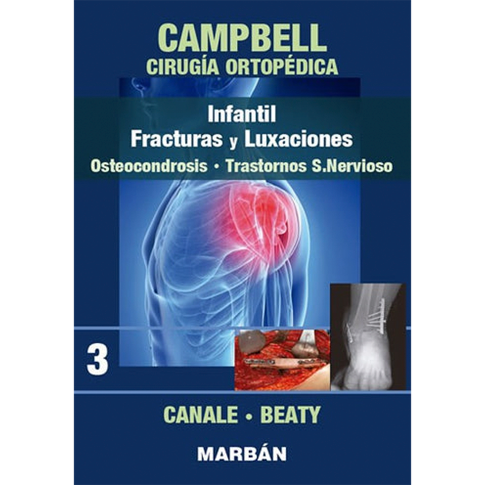 Cirugía Ortopédica - Infantil, Fracturas y Luxaciones, Osteocondrosis, Trastornos S.Nervioso. Tomo 3